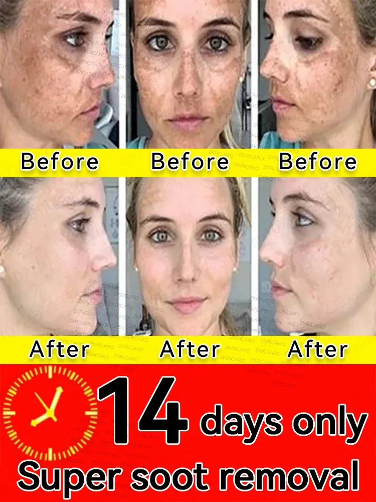 Color: black - ?โฆ?ยซ๐๐?ยค๐ฅ๐ ?ยซ๐?ยฆ๐จ๐ฏ๐๐ฅ Laser Therapy to Heal Spots